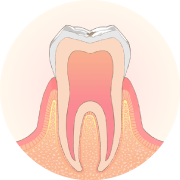 歯の表面に小さなむし歯ができます