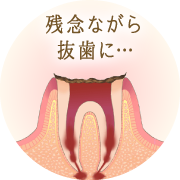 神経が死んでしまうと、痛みを感じなくなります