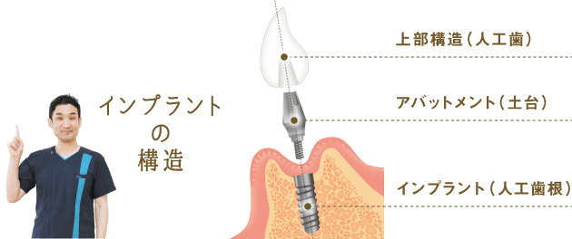 インプラントの構造