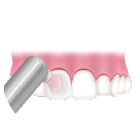 歯の表面をツルツルに仕上げ磨き